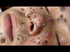 Loan Nguyen Acne Treatment 3yy