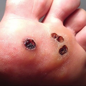 CHỮA BỆNH MẮT CÁ Ở CHÂN TẬN GỐC BẰNG MẸO DÂN GIAN!!! Điều trị mắt cá chân có thể dùng phương pháp đốt điện, tia laser, chấm azote lỏng hoặc tiểu phẫu. Nhưng đơn giản và an toàn nhất vẫn là cách chữa mắt cá ở chân tận gốc bằng mẹo dân gian. Các bạn hãy cùng Benh.vn tham khảo và áp dụng một số bài thuốc dân gian chữa mắt cá chân hiệu quả sau nhé :) | Benh.vn