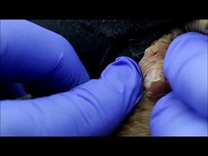 1.2 Draining an Abscess