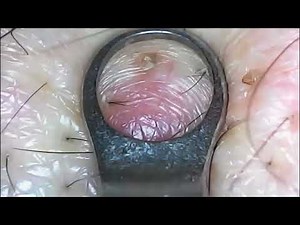 “Extreme Pimple Popping That Will Blow Your Mind! 😳 (Blackheads & Whiteheads Edition)”