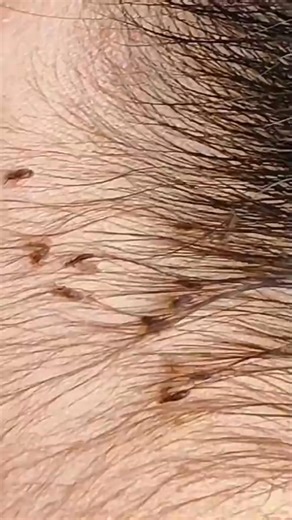 Lice (kuto) #piojos #poux #nguyen #ticks #satisfying ,#popping #piolhos #hanoi #fleas #thai #brasil | Lusiana