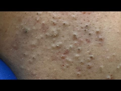 Deep Cleansing Techniques for Oily Skin — Blackhead Removal Secrets