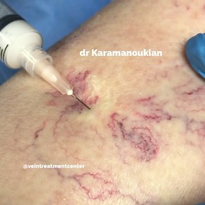 Sclerotherapy for spider and reticular veins. Once the sclerosant...