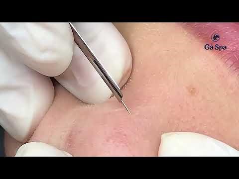 The Service in Our Spa: Blackhead & Hidden Acne Removal.