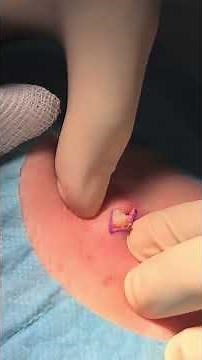 Big Squeeze- Cyst RUPTURE, Popped