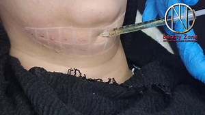 Injection lypolisis double-menton حقن تذويب دهون الذقن المزدوج و تحديد الوجه | Beauty Zone - بيوتي زون