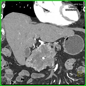 28 reactions | Serous Cystadenoma 4 | CTisus: Cutting edge information on body CT (Computed tomography). | Facebook