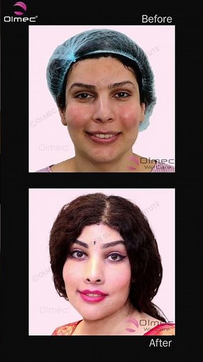 Incredible Transformation After Facial Feminization Surgery | Dr. Narendra Kaushik
