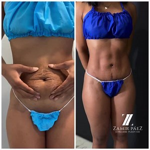 Mommy Makeover: Lipoabdominoplasty with Mastopexy for a Complete Transformation