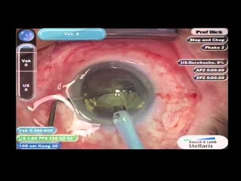 Kataraktchirurgie mit Femtosekundenlaser - Laser-assisted Cataract Surgery (University of Bochum)