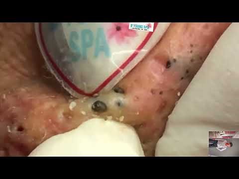 blackhead removal from nose/ old aged blackheads removal | #141