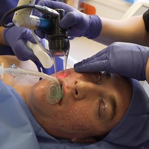 CO2 Deep FX Laser for Treating Acne Scars