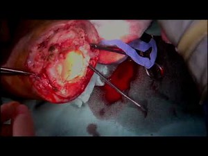 Below Knee Guillotine Amputation