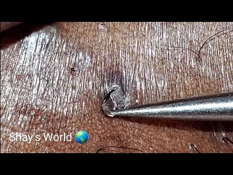 INGROWN HAIR REMOVAL #27