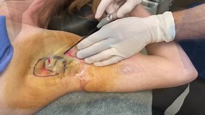 Hyperhidrosis Procedure