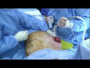 Breast Implants & Breast Lift Surgery • Video • MEDtube.net