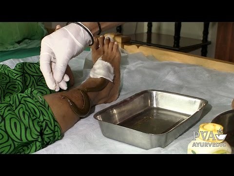 PVA: Raktamokshana - Leeches (Blood-Letting) Ayurveda Therapy