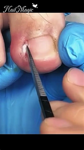Ingrown nail removal ⚡⚡⚡ #satisfying #simplenails #nails #shiningnails #footnailcare