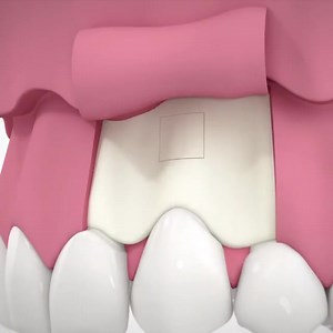 #apicoectomy #tipsandtricks #3danimation #dentalclinic #Surgery | Dr Moin Khan