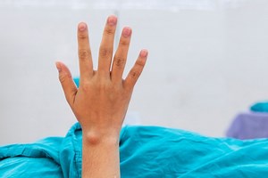 Sebaceous cyst: an overview of this epidermoid cyst