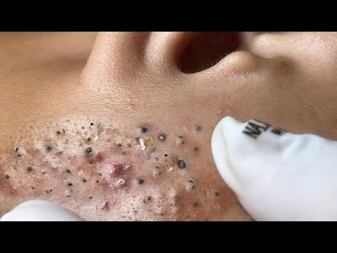 Big Cystic Acne Blackheads Extraction Blackheads, Whiteheads Removal Pimple Popping VS