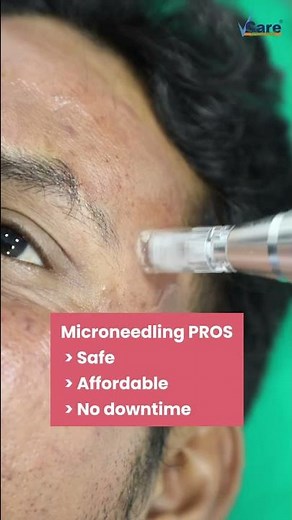 Microneedling Procedure at VCare | Best Treatment For Acne, Acne Scars, Wrinkles & Fine Lines