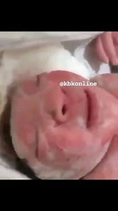 Anencephaly A baby born with an underdeveloped brain and an incomplete skull. Anencephaly is a defect in the formation of a baby's neural tube during development. A baby born with anencephaly might be stillborn or survive only a few hours to a few days after birth. #kbkfoundation | Kbkonline