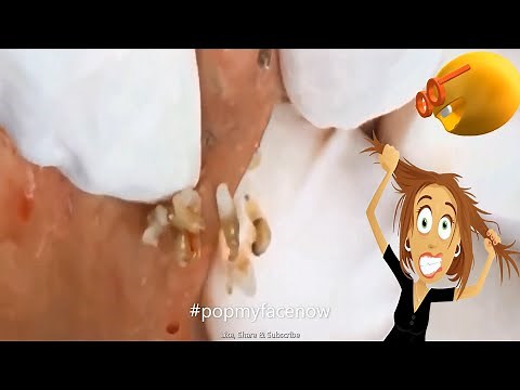 GREATEST ACNE EXTRACTION PART#16🎵🤓 [WHITEHEAD/BLACKHEAD] EXPLOSION 2020 #popmyfacenow