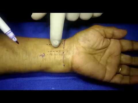 Carpal Tunnel Steroid Injection