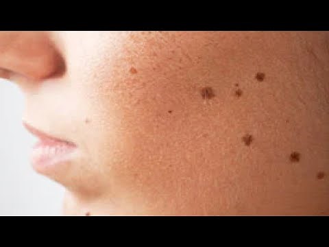 how to get rid of beauty marks on your face