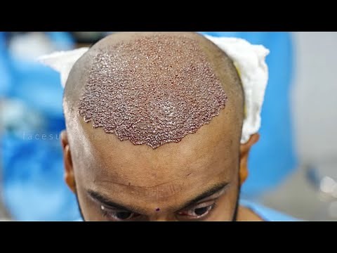 Hair Transplant Live Surgery | Hair Transplant FUE Technique| Best Hair Transplant results