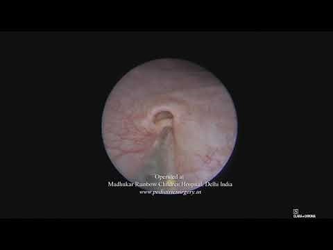 Endoscopic Dextranomer/Hyaluronic Acid Injection (Dexell®) for vesicoureteral reflux (VUR)