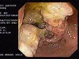Adenocarcinoma of the Ascending Colon • Video • MEDtube.net