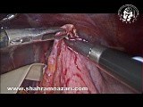 Laparoscopic Heller Myotomy • Video • MEDtube.net
