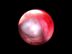 Nasopharyngeal polyp in a cat