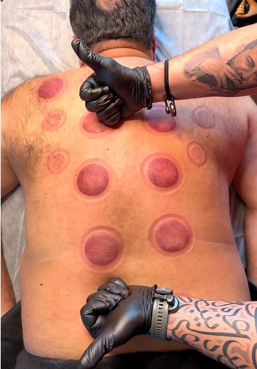 Hijama: Powerful Cupping Therapy for Deep Relief | HijamaPro360
