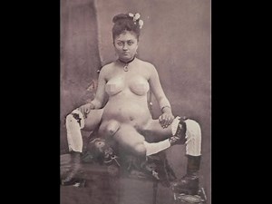 Tìm hiểu về người phụ nữ kỳ lạ có 3 chân và 2 âm đạo riêng biệt