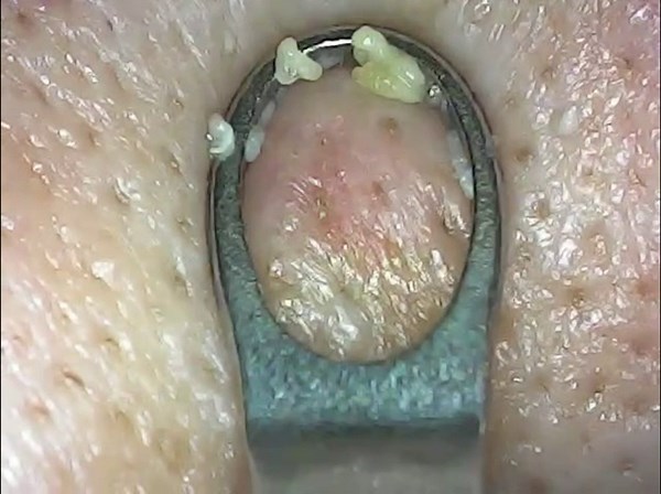 Men’s Visible Blackhead Remover[2022 New], Advanced Pimple Popper with 20X Camera, womfenn Comedone Acne Extractor Pore Cleaner Blemish Extraction Tools Kit