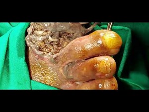 maggot infestation in a wound