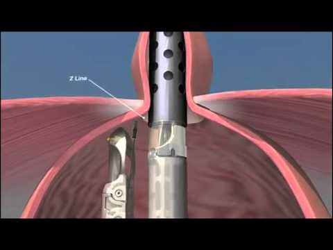 Transoral Incisionless Fundoplication (TIF) procedure animation