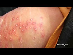 Pustular Lesions Neonate