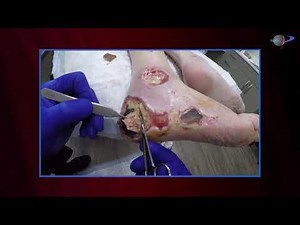 WCW: Determining When to Debride Eschars