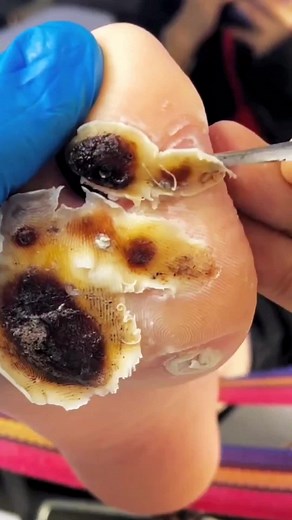 How to Treat an Infected Big Toe Effectively