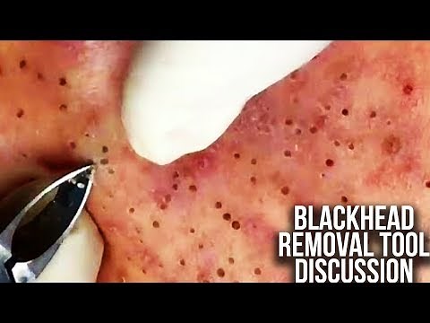 Pimples Popping Compilation: Flying Pimples (Comedone Extractor Tools Review)