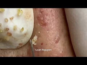 ACNE REMOVAL BLACKHEADS | LOAN NGUYEN