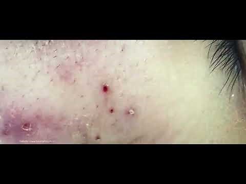 Big Cystic Acne Blackheads Extraction Blackheads & Milia, Whiteheads Removal Pimple Popping