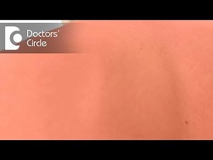 Does sunburn mean that you are going to get Skin Cancer? - Dr. Aruna Prasad