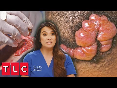 Massive Keloid Removal: Dr. Lee Calls in a Specialist (Part 2) | Dr. Pimple Popper