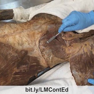 For more info: bit.ly/LMContEd 🌟🌟 . Gluteus medius cadaver video #2. The gluteus medius can be looked at as the “deltoid of the hip”. 👍👍 . This video clip is from a longer video lesson on LearnMuscles Continuing Education (LMCE), my video streaming subscription service for manual therapists and movement professionals. 🌟🌟 . The gluteus medius attaches proximally to the iliac crest and distally to the greater trochanter of the femur. 😊😊 . Like the deltoid, the gluteus medius has anterior f