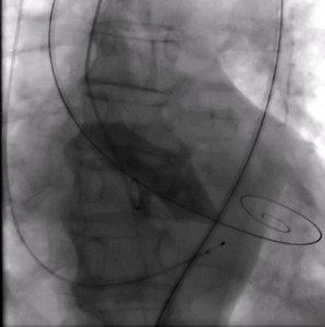 🚨 Part 2 of the #TAVI case in a severely calcified aortic stenosis with a large annulus, shared by Niklas Schofer, is now available! Learn how the team managed an 89-year-old patient with worsening heart failure symptoms, a history of permanent atrial fibrillation, and chronic renal failure. Available in German and #EBAC accredited! Watch the case here➡️ https://bit.ly/3CJfmVw | PCRonline